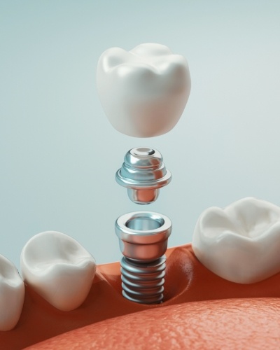 Illustrated dental implant replacing a missing tooth