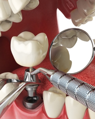 Illustrated dental implant being placed in the lower jaw