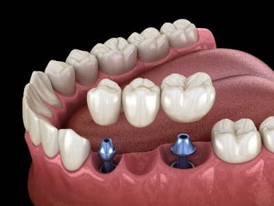 Illustrated dental bridge being placed onto two dental implants