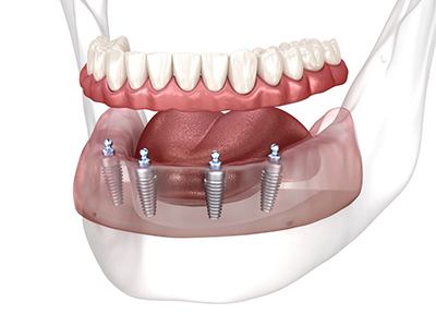 Illustration of implant denture for lower arch