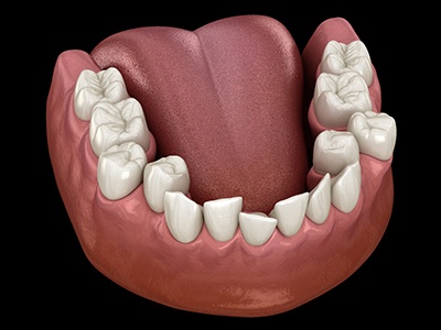 Illustration of crowded teeth