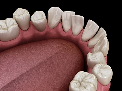 Illustration of gapped teeth