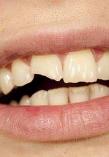 Closeup of a broken tooth