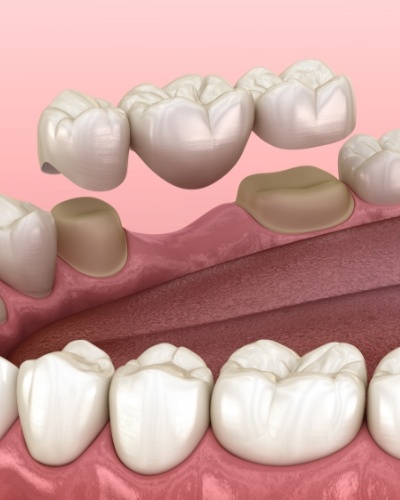 Illustrated dental bridge replacing a missing tooth