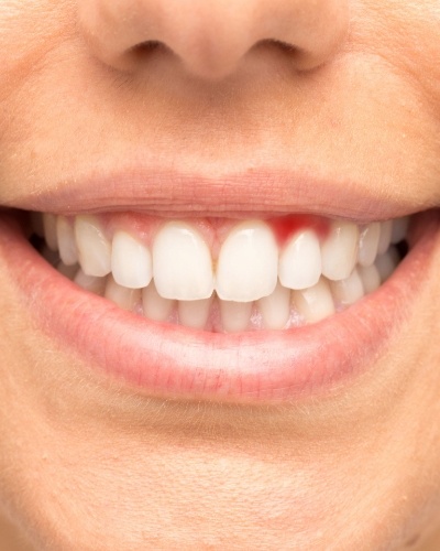 Close up of smile with red spot in gums