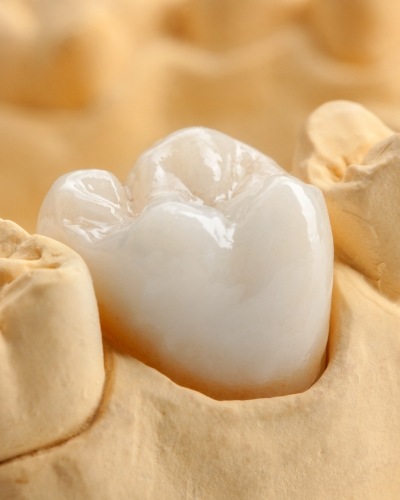 Model of the mouth with dental crown over one tooth