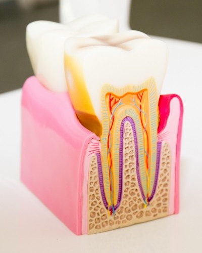 Model of decayed tooth needing root canal treatment