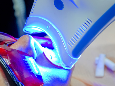Patient in Mississauga getting in-office teeth whitening