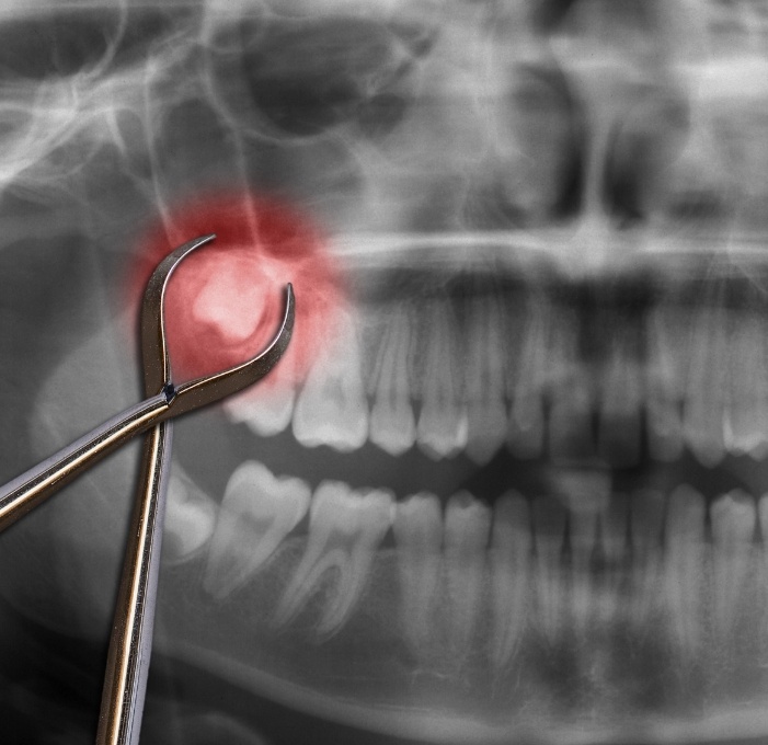 Dental forceps in front of x ray showing impacted wisdom tooth