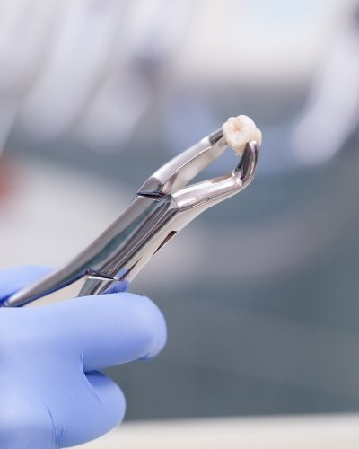 Dental forceps holding tooth after wisdom tooth extractions in Mississauga